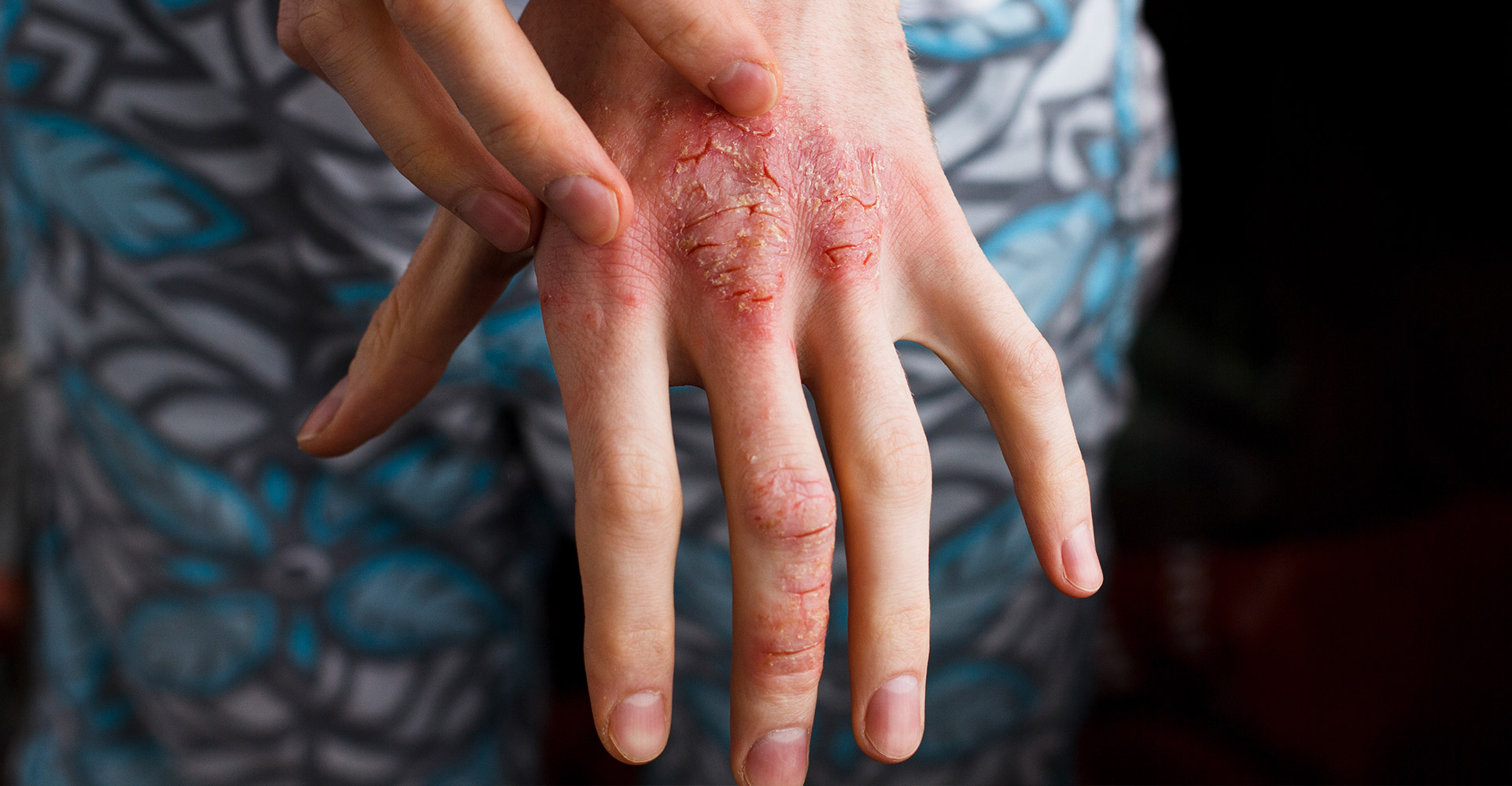 psoriasis