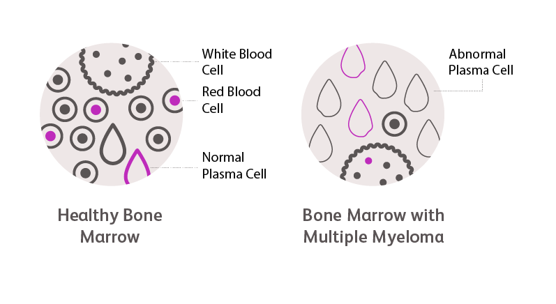 Healthy bone marrow