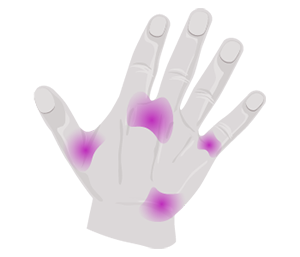 Systemic sclerosis